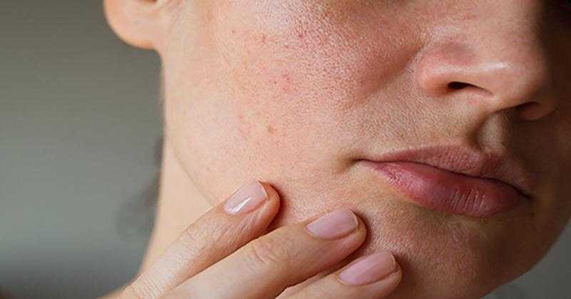 الوقاية من الأمراض الجلدية: دليلك الشامل للحفاظ على صحة بشرتك