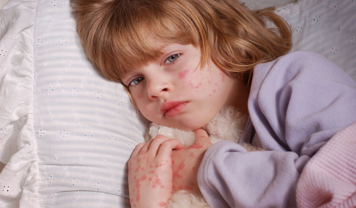 المضادات الحيوية تصيب طفلك بالحساسية والإكزيما