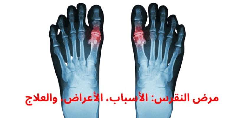 النقرس